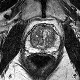 Normal gland anatomy, no lesion (Case 74) T2 axial source preview