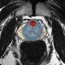 Transition-zone lesion, mid-gland (Case 75) MRI preview