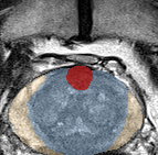 Transition-zone lesion, mid-gland (Case 75) lesion zoom preview