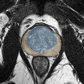 Normal gland anatomy, no lesion (Case 76) MRI preview