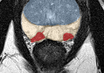 Peripheral-zone lesion, apex (Case 77) lesion zoom preview