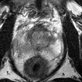 Peripheral-zone lesion, mid-gland (Case 78) T2 axial source preview