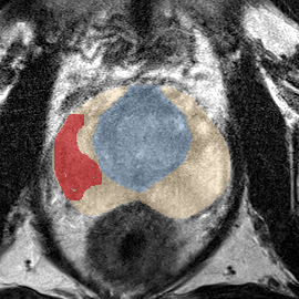 Peripheral-zone lesion, mid-gland (Case 78) MRI preview