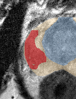 Peripheral-zone lesion, mid-gland (Case 78) lesion zoom preview