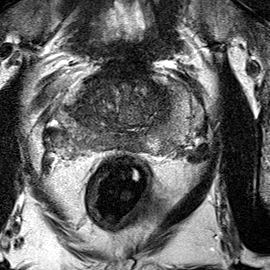 Normal gland anatomy, no lesion (Case 79) T2 axial source preview