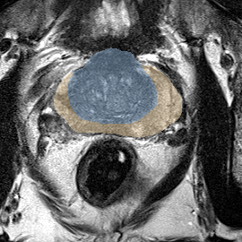 Normal gland anatomy, no lesion (Case 79) MRI preview