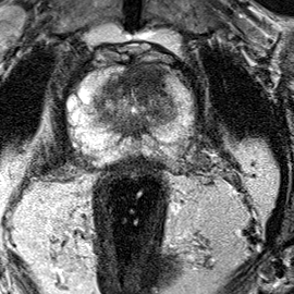 Transition-zone lesion, apex (Case 80) T2 axial source preview