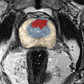 Transition-zone lesion, apex (Case 80) MRI preview