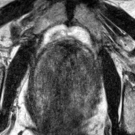 Transition-zone lesion, mid-gland (Case 82) T2 axial source preview