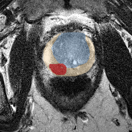 Peripheral-zone lesion, mid-gland (Case 83) MRI preview