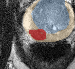 Peripheral-zone lesion, mid-gland (Case 83) lesion zoom preview