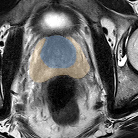 Normal gland anatomy, no lesion (Case 84) MRI preview
