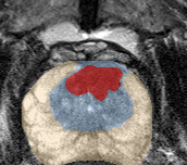 Transition-zone lesion, apex (Case 85) lesion zoom preview