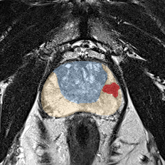 Peripheral-zone lesion, apex (Case 87) MRI preview