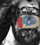 Peripheral-zone lesion, apex (Case 88) lesion zoom preview