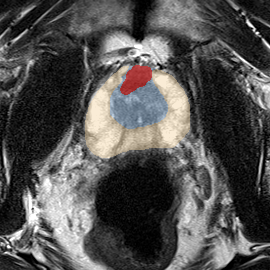 Transition-zone lesion, mid-gland (Case 89) MRI preview
