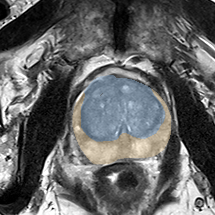 Normal gland anatomy, no lesion (Case 90) MRI preview