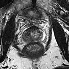 Peripheral-zone lesion, base (Case 91) T2 axial source preview