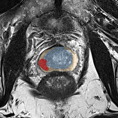 Peripheral-zone lesion, base (Case 91) MRI preview