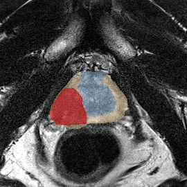 Peripheral-zone lesion, apex (Case 92) MRI preview