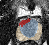 Transition-zone lesion, apex (Case 93) lesion zoom preview