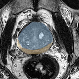 Normal gland anatomy, no lesion (Case 94) MRI preview