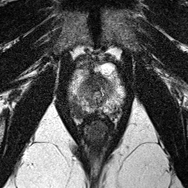 Peripheral-zone lesion, apex (Case 95) T2 axial source preview