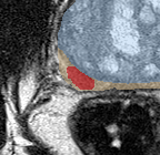 Peripheral-zone lesion, mid-gland (Case 96) lesion zoom preview
