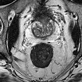 Transition-zone lesion, mid-gland (Case 97) T2 axial source preview