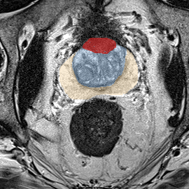 Transition-zone lesion, mid-gland (Case 97) MRI preview