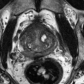 Normal gland anatomy, no lesion (Case 98) T2 axial source preview