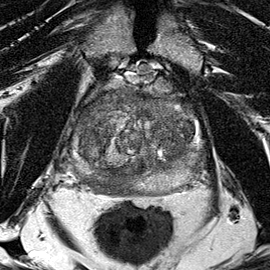 Peripheral-zone lesion, apex (Case 99) T2 axial source preview