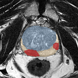 Peripheral-zone lesion, apex (Case 99) MRI preview