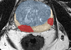 Peripheral-zone lesion, apex (Case 99) lesion zoom preview