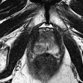 Transition-zone lesion, apex (Case 100) T2 axial source preview