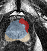 Transition-zone lesion, apex (Case 100) lesion zoom preview